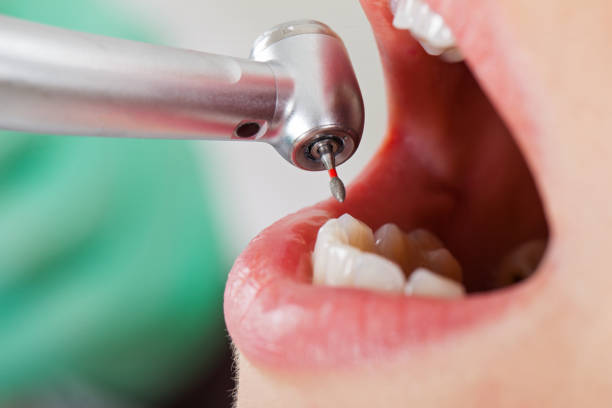 Best Chipped Tooth Repair Near Me  in Rockingham, NC